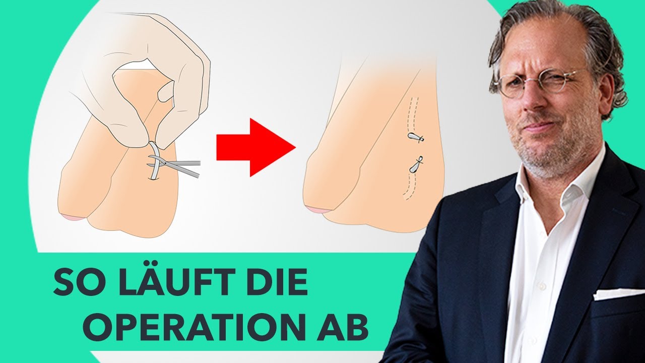Vasektomie beim Mann: Ablauf, Schmerzen & Erfahrung